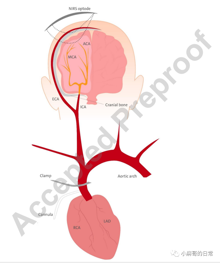 麻醉監(jiān)測||腦外污染對局部腦血氧飽和度監(jiān)測的影響(圖2)