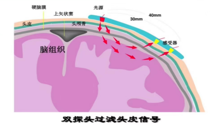 腦氧監(jiān)測(cè)在圍術(shù)期的應(yīng)用(圖2)
