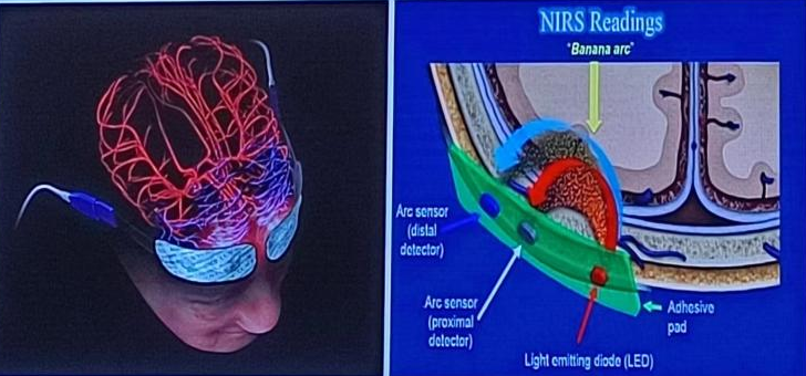 腦氧監(jiān)測(cè)在圍術(shù)期的應(yīng)用(圖3)