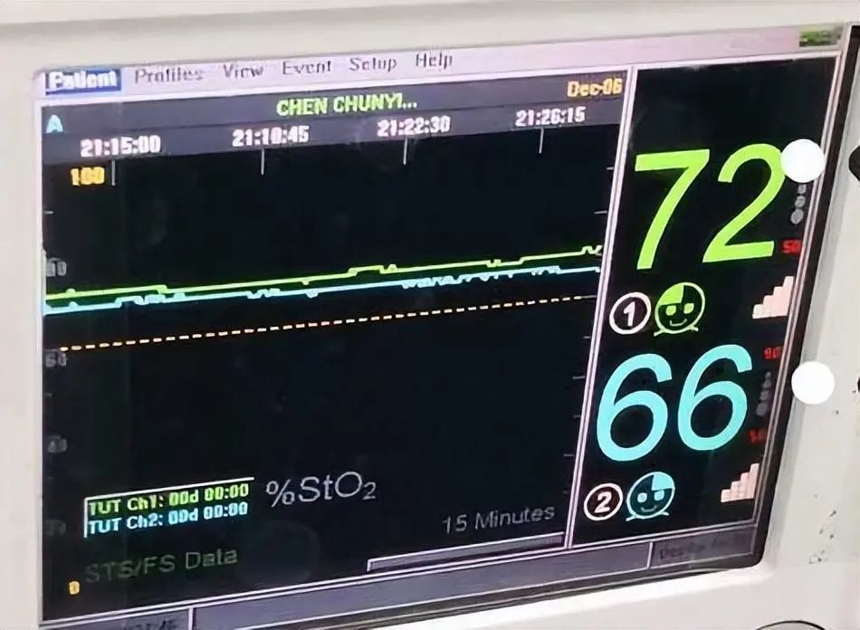 腦氧監(jiān)測(cè)在圍術(shù)期的應(yīng)用(圖5)